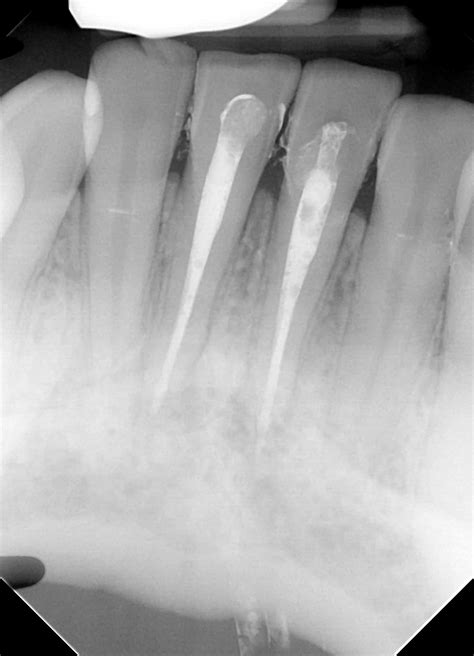 Root Canal Front Tooth Before And After