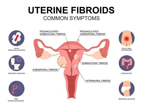 Body Changes After Myomectomy | American Fibroid Centers