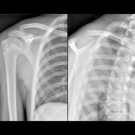 Clavicle Fracture | Pediatric Radiology Reference Article | Pediatric Imaging | @pedsimaging