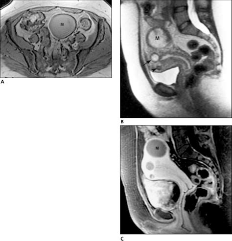 A Degenerating Cystic Uterine Fibroid Mimicking an Endometrioma on ...