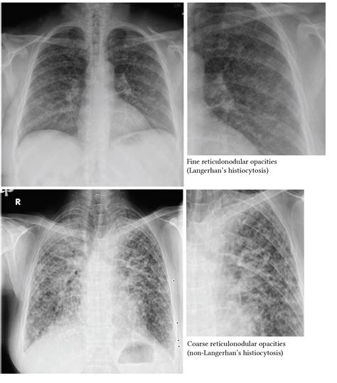 Chest Xray interpretation in ICU | Deranged Physiology