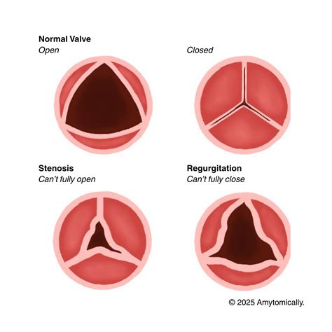 Valvular Heart Diseases – Amytomically