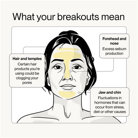 Experiencing Acne On Your Cheeks? Here's how to Treat it | Software