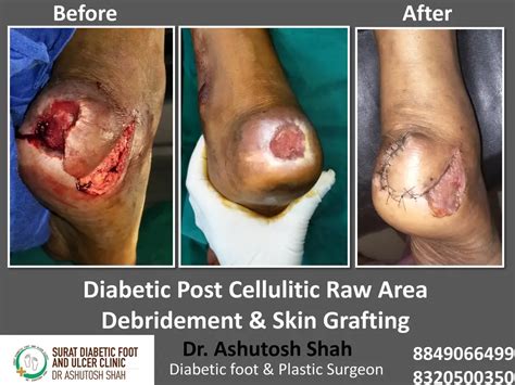 Transformations Gallery-Surat Diabetic Foot and Ulcer Clinic
