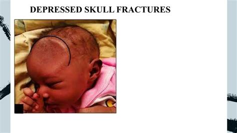 BIRTH INJURY.pptx