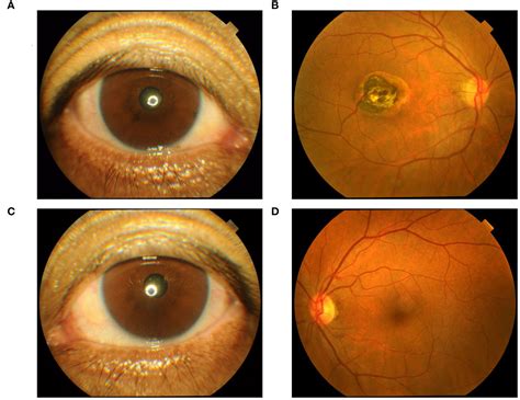 Frontiers | Hydroxychloroquine-induced hyperpigmentation of the skin and bull’s-eye maculopathy ...