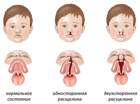 Ринолалия: формы нарушения, причины возникновения и лечение