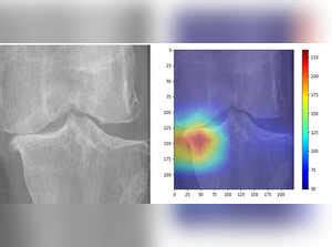 Knee Osteoarthritis: IIT-Guwahati develops framework to assess Knee ...