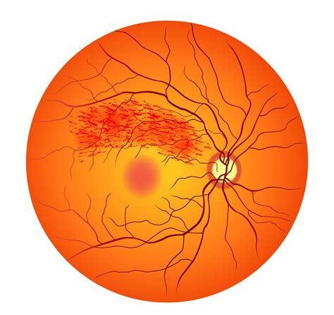 Branch Retinal Vein Occlusion