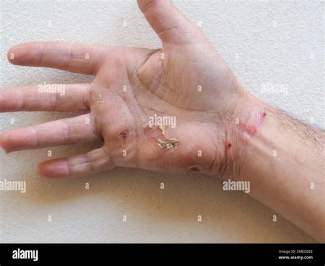 Electrical Burns Entry Exit