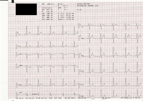 Normal Sinus Rhythm Ecg Values Sale Online | vivatumusica.com