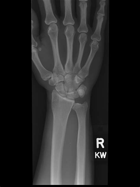 Daily Dose: Negative ulnar variance