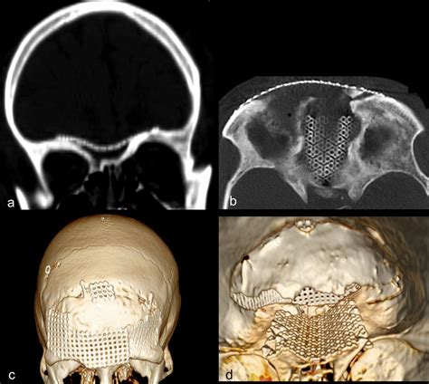 Reconstruction of the anterior skull base after major trauma or ...