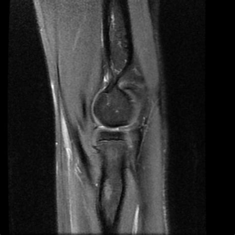 Image result for Elbow Cysts Explode