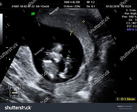 12 Week Ultrasound Pictures