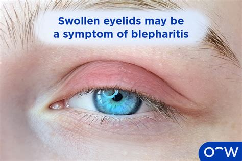 Blepharitis: Types, Causes, Symptoms, Diagnosis, and Treatments