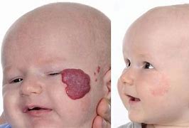Image result for Infant Hemangioma