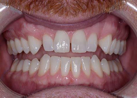 101 Guide to What Causes White Spots on Teeth