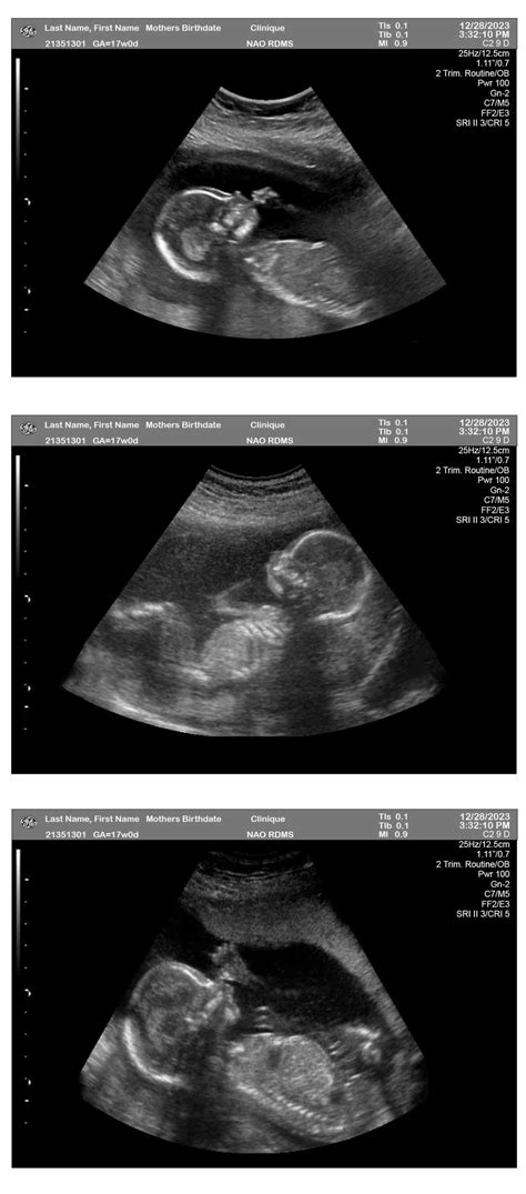 Cheap Pregnancy Ultrasound at Zara Baillieu blog