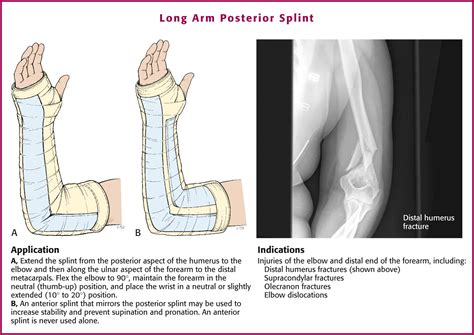 Splinting Techniques - Clinical Tree