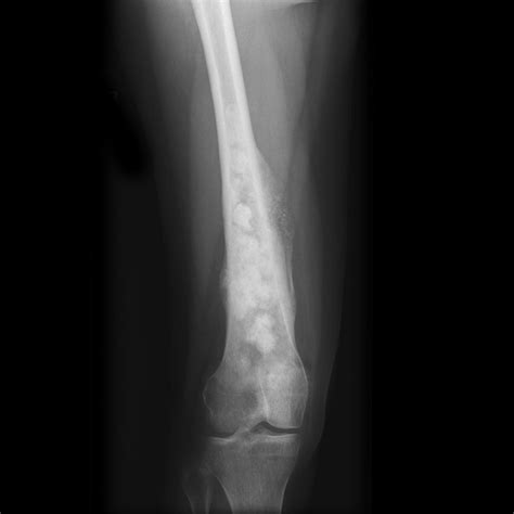 Osteosarcoma x ray - wikidoc