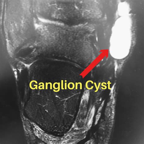 Foot Cysts And Tumors
