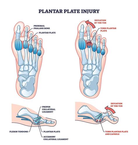 Plantar Plate Tear: Causes, Symptoms, and Treatment Options