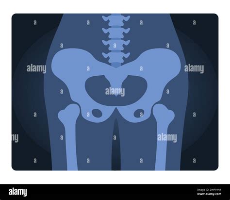 Xray shot of human pelvis. Medical skeleton test, body radiography cartoon vector illustration ...