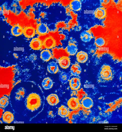 Epstein-Barr viruses (EBV). Coloured transmission electron micrograph of Epstein-Barr viruses in ...