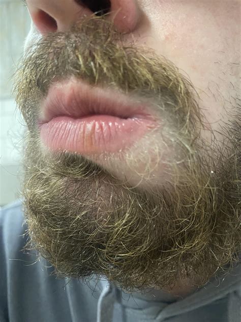 Angular Cheilitis or cold sore? : r/skin