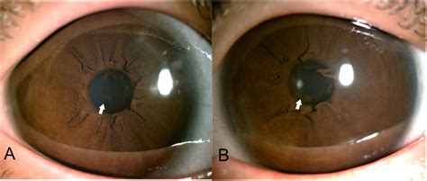 A rare case report of bilateral persistent pupillary membranes: Surgical intervention restoring ...