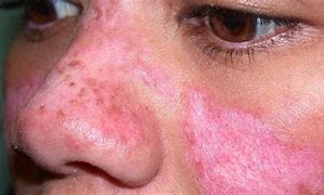 Image result for Lupus