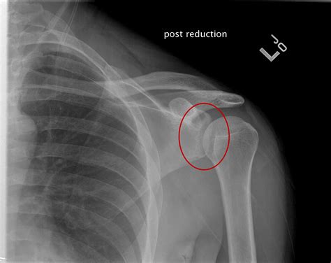 X Ray Shoulder Anatomy