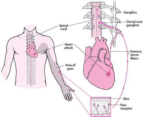Figure: What Is Referred Pain? - MSD Manual Consumer Version