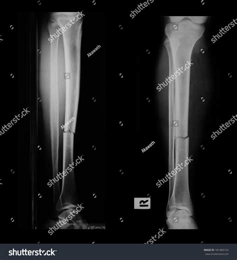Xray Broken Leg Fracture Tibia Stock Photo 181483154 | Shutterstock