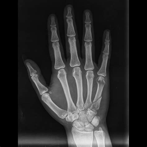 Broken Hand X Ray