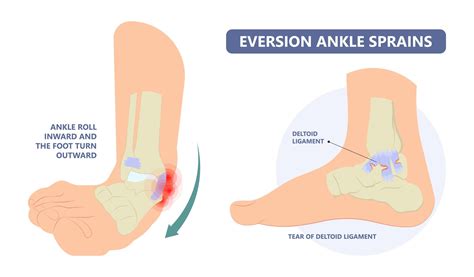 Ankle Injuries in Volleyball - Rehab 49