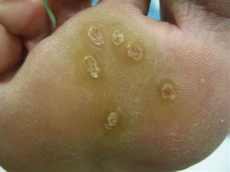 Plantar Warts | 🩺Singapore Sports & Orthopaedic Surgeon