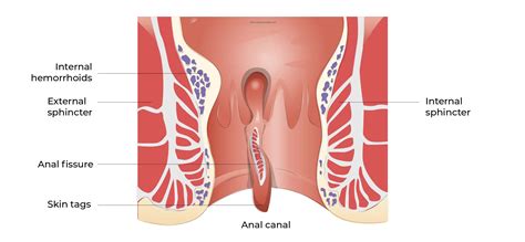 Fissure In Anus Surgery