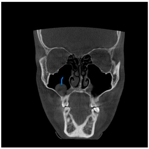 Prevalence of Incidental Maxillary Sinus Anomalies on CBCT Scans: A ...