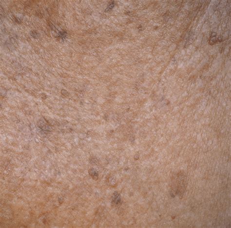 Actinic keratosis | Devonshire Dermatology | London