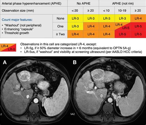 CT-MRI LI-RADS v2017: A Comprehensive Guide for Beginners
