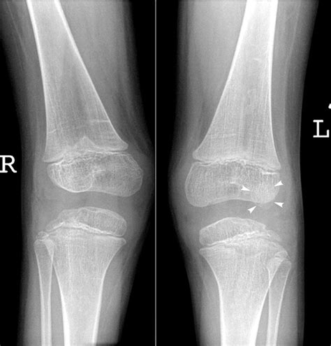 Signs Of Dislocated Patella at Bernadette Williams blog