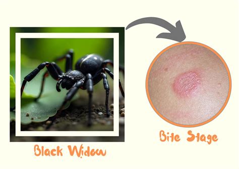 Black Widow Spider Bite Stages, Symptoms with Pictures (Identification)