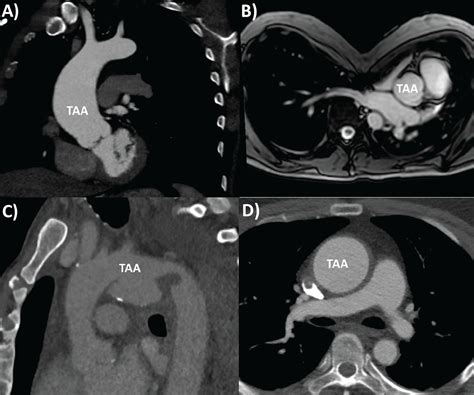 Thoracic aortic aneurysm: Optimal surveillance and treatment ...