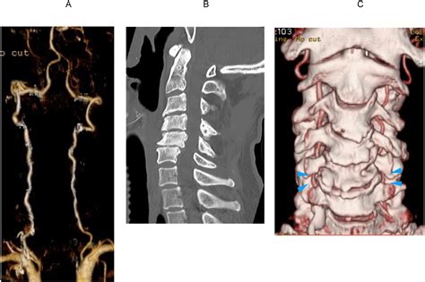 Treatment of rotational/positional vertebral artery occlusion due to degenerative changes in the ...