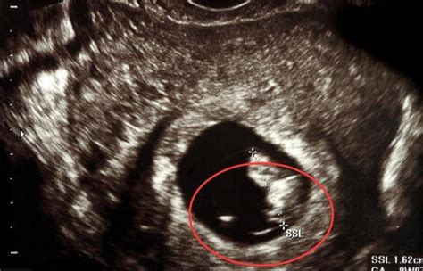 胎芽大小与孕周对照表，孕妈们可以对比一下是否正常