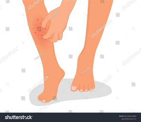 Itchy Rash On Lower Legs