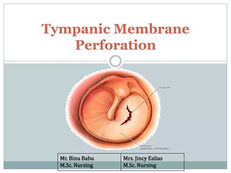 Tympanic Membrane Perforation