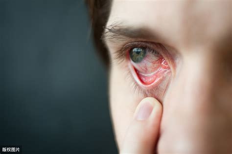 眼睛痒肿是怎么回事怎么办（眼睛红肿，畏光发痒要注意，是这种眼睛的春季高发病症要来临） | 说明书网
